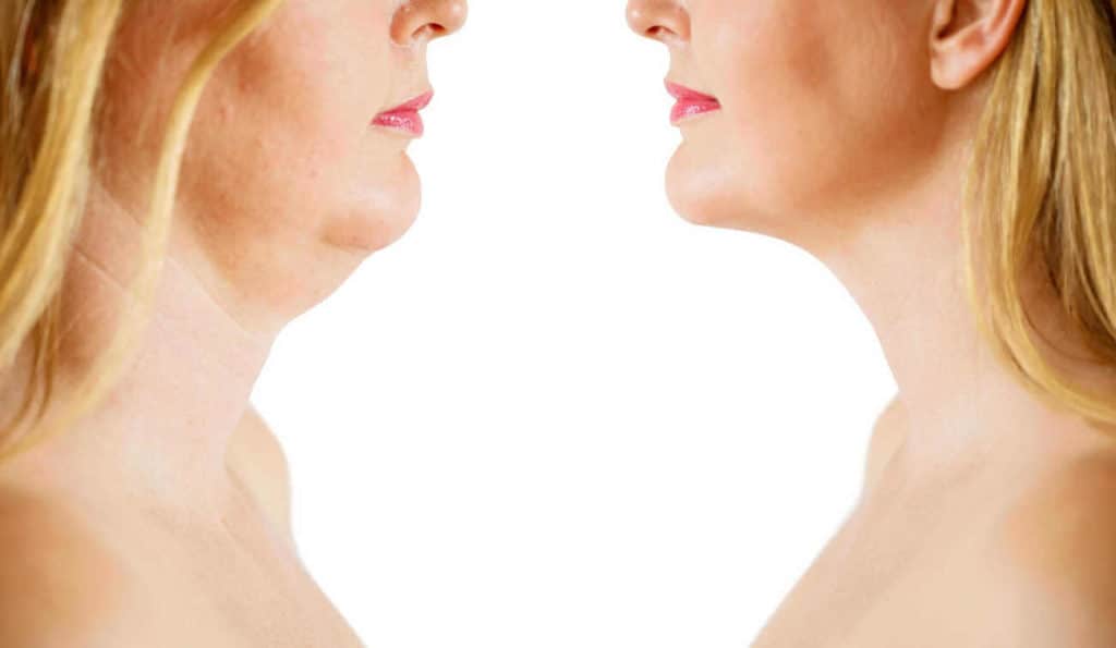 Double Chin treatment Greenford before and after results
