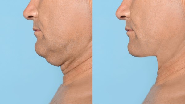 Which Non-Surgical Treatments Work Best for Jowls and Loose Skin Greenford?