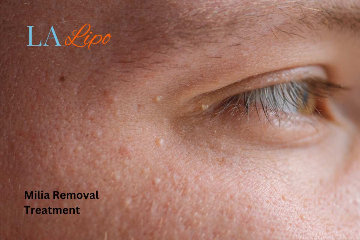 Cryopen Milia Removal: Is It the Easiest and Safest Option Greenford?