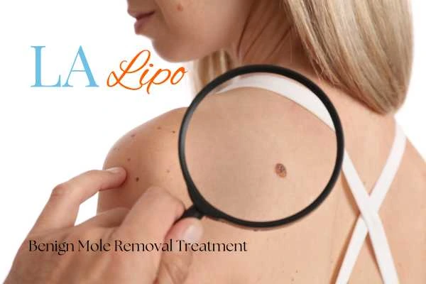 Woman having her inspection of blemish before mole removal Greenford