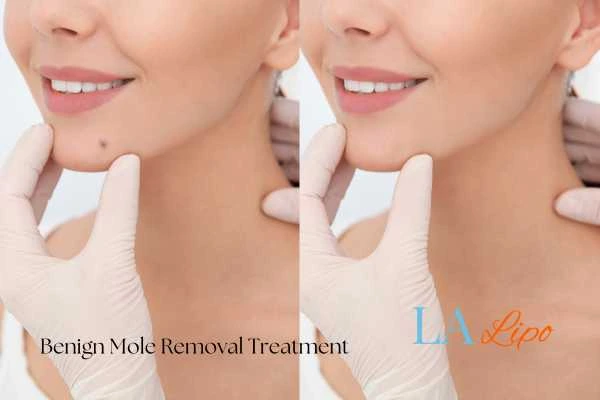 Before and after mole removal Greenford treatment
