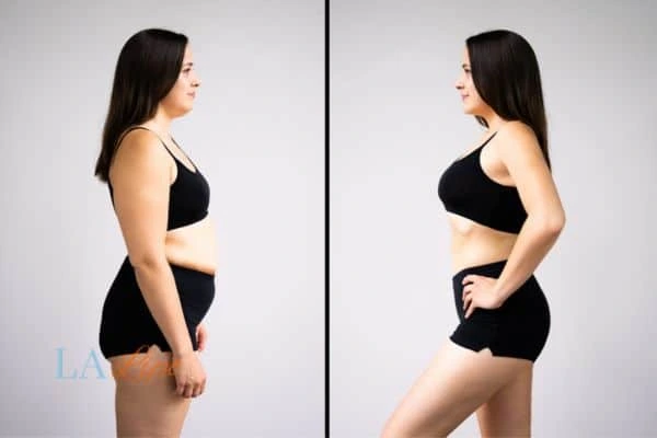 image of woman before and after results of LA-EMS Body Sculpting Greenford to help treat Diastasis recti