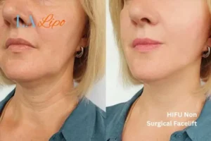 hi-fu for wrinkles Greenford before and after results