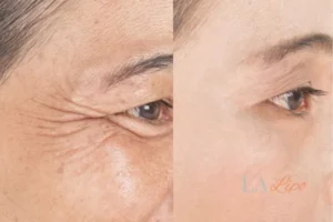 Before and after results of woman - HI-fu wrinkles reduction treatment Greenford