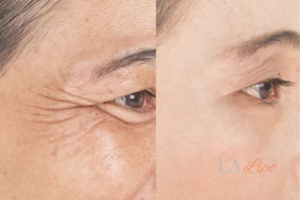 Before and after results of woman - HI-fu wrinkles reduction treatment Greenford