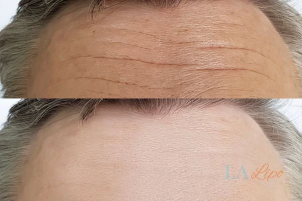 results of HIFU Greenford on mans forehead to help reduce lines and wrinkles