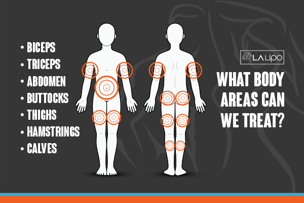 Graphic to show areas you can have LA-EMS Body Sculpting Greenford treatment.