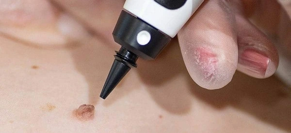 skin tag removal using cryopen Greenford