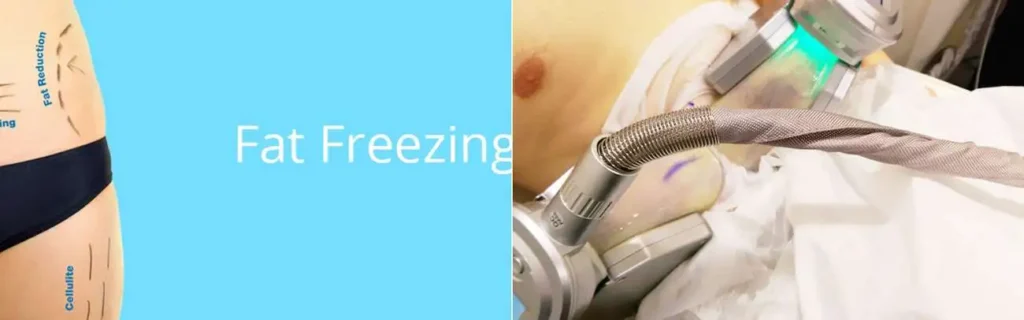 multi areas of a persons body having coolsculpting Greenford treatment
