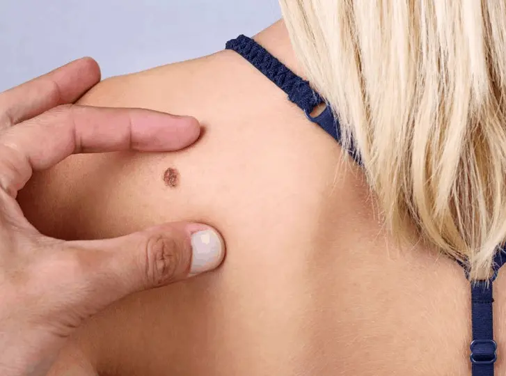 woman having mole removal Greenford consultation before treatment.