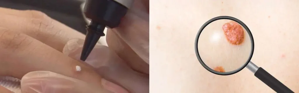 Cryopen for mole removal Greenford - speak to our team today!