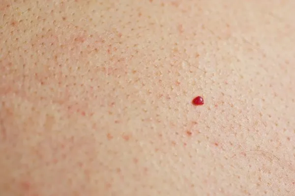 close up of a cherry angioma Greenford