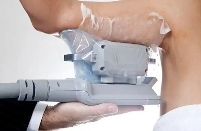 Picture of fat freezing Greenford on the upper arms.