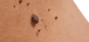 image of a skin tag Greenford