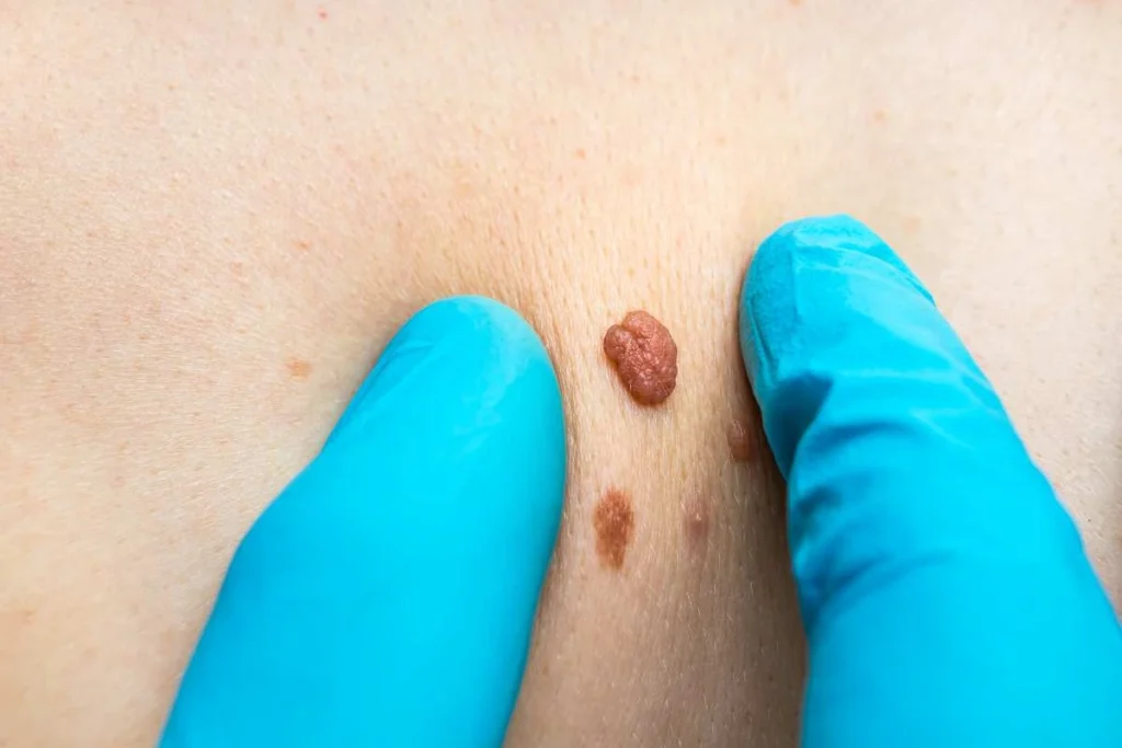Consultant examining a skin tag Greenford