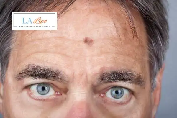 Solar Lentigo Removal Greenford image of man with mark on his forehead