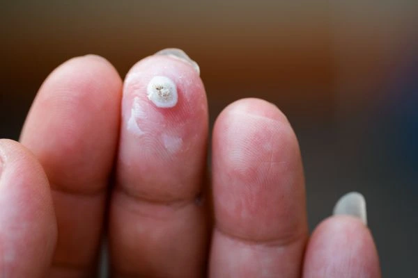 wart on person finger - cryotherapy to treat from LA LIPO Greenford