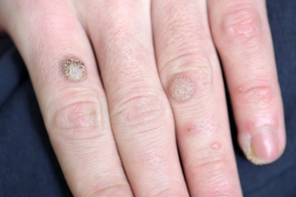 photo of warts on person hand - see wart removal Greenford from LA LIPO