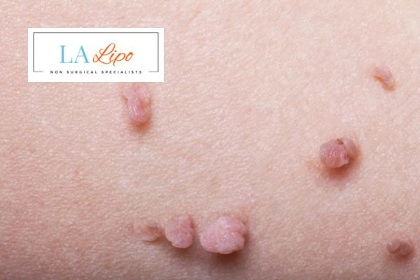 Does cryopen skin tag removal Greenford hurt? Find out now call our team today!