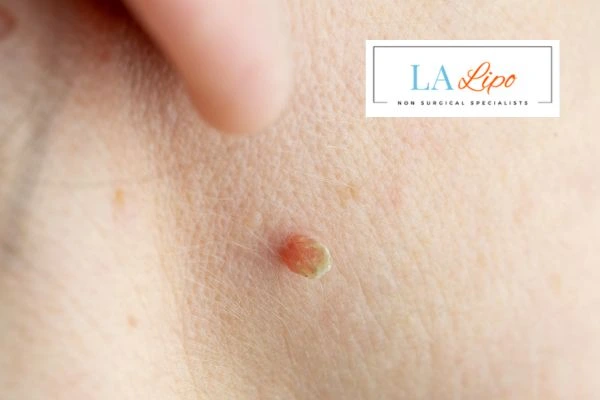Book skin tag removal Greenford today speak to our team now!