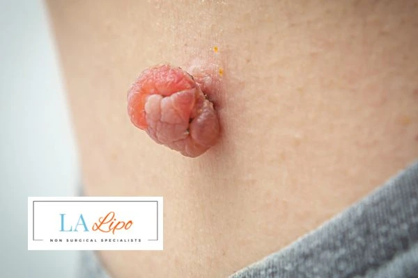 Interested in skin tag removal Greenford? Concerned about the pain? Find out more today!