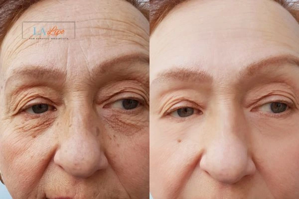 The powerful benefits of Morpheus8 Treatment Greenford - Call Our team today!