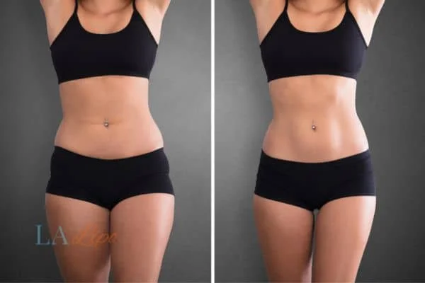 before and after results of non-surgical treatment to help a woman's body image and mental health Greenford