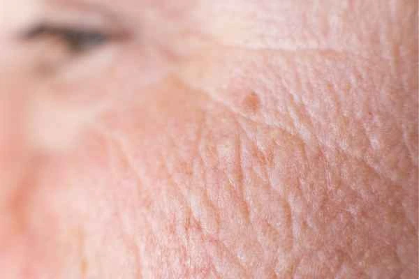 close up picture of a woman's face showing an age spot Greenford