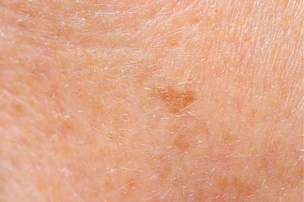 close up picture of age spots Greenford