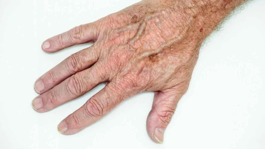 Male hand showing age spot Greenford