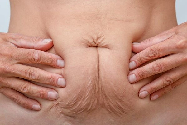 Image of a woman's stomach with loose skin - example of skin tightening Greenford options