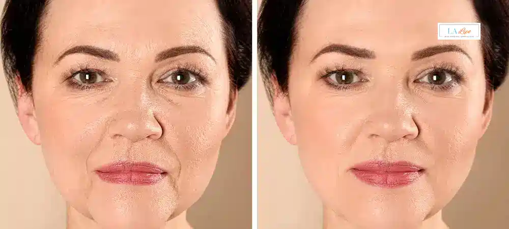 How Long Does It Take to See Results and How Long Do They Last Greenford?