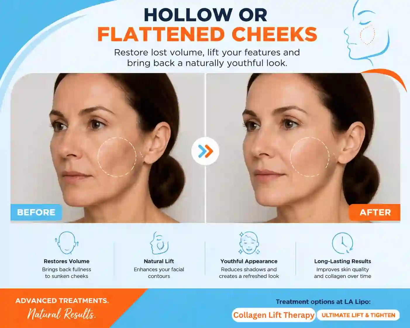 Sign #4: Hollow or Flattened Cheeks Greenford