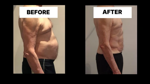 What Symptoms Can Diastasis Recti Cause in Men? Weak Core, Back Pain and Poor Posture Greenford